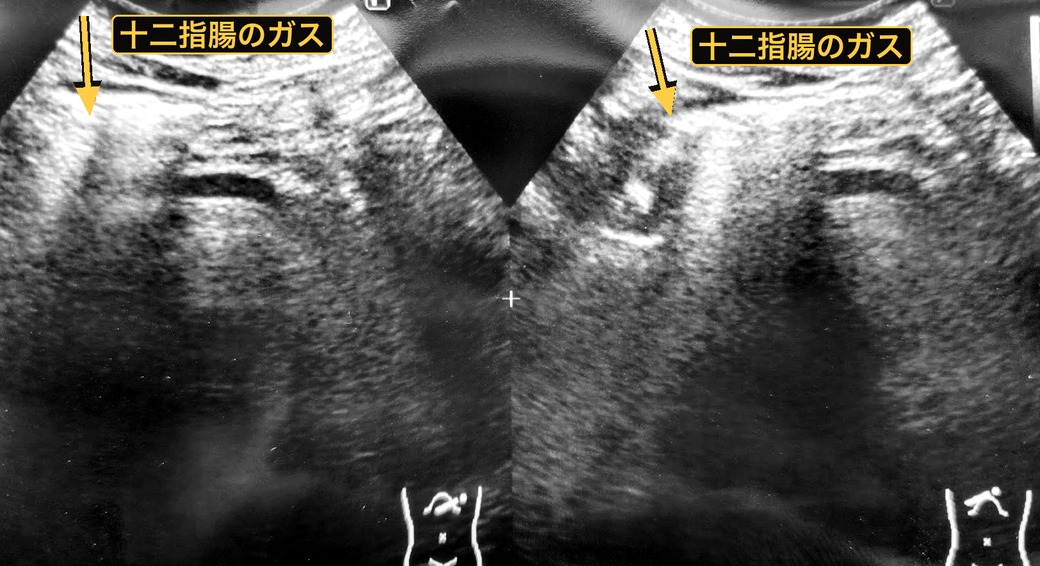 十二指腸のガスにさえぎられて奥が見えない腹部エコー画像