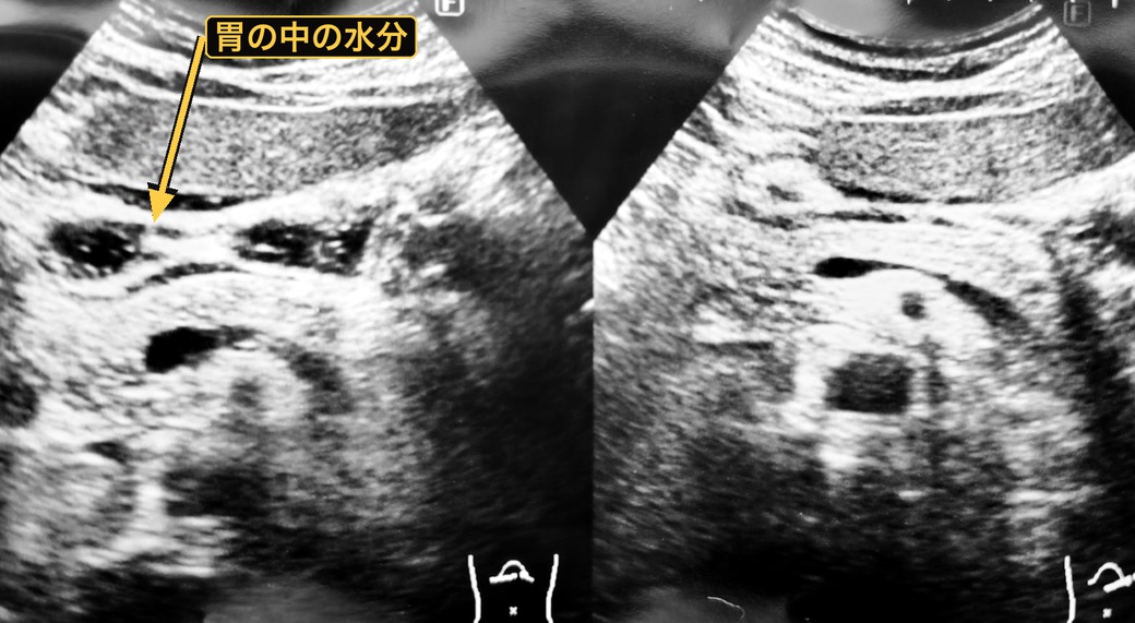 胃に水分があることで奥まで観察できている腹部エコー画像