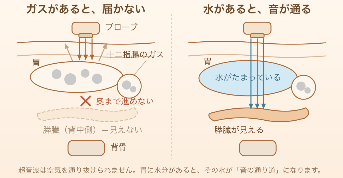ガスがあると超音波が膵臓まで届かず、胃に水分があると音が通って膵臓が見えることを示した図
