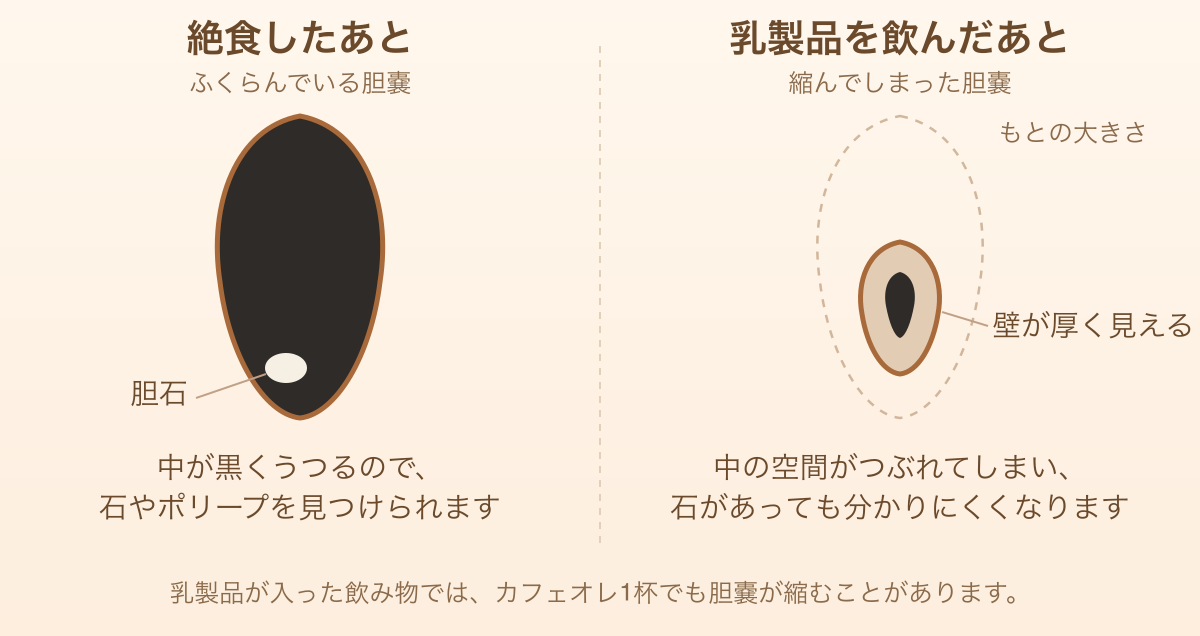 絶食後のふくらんだ胆嚢と、乳製品摂取後に縮んだ胆嚢を比べた図
