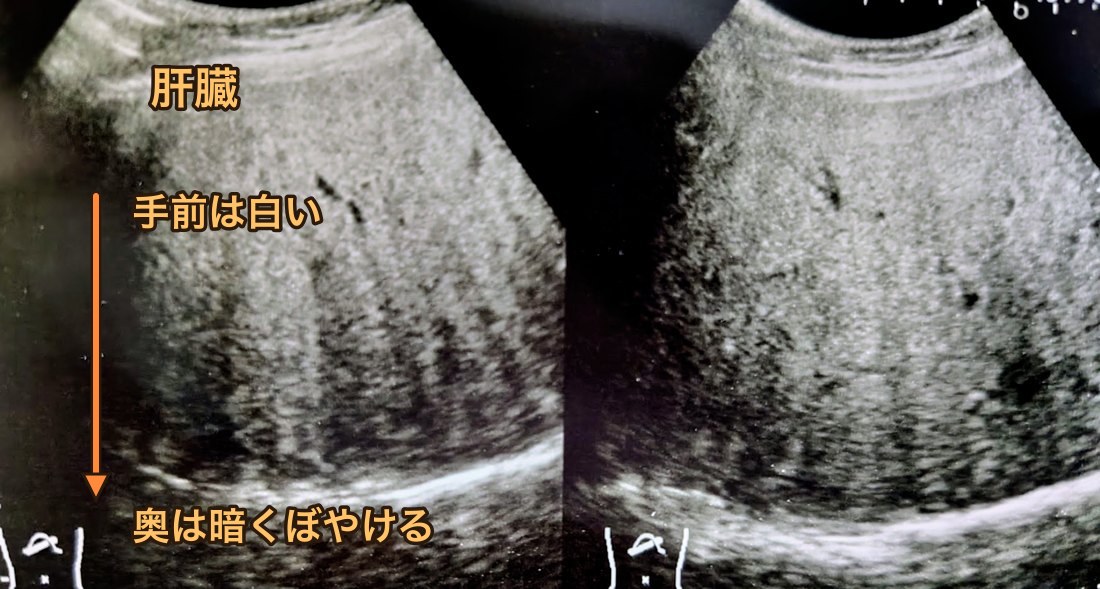 脂肪肝の腹部エコー画像。手前は白く、奥は深部減衰で暗くぼやけ、すだれ状のエコーが見える