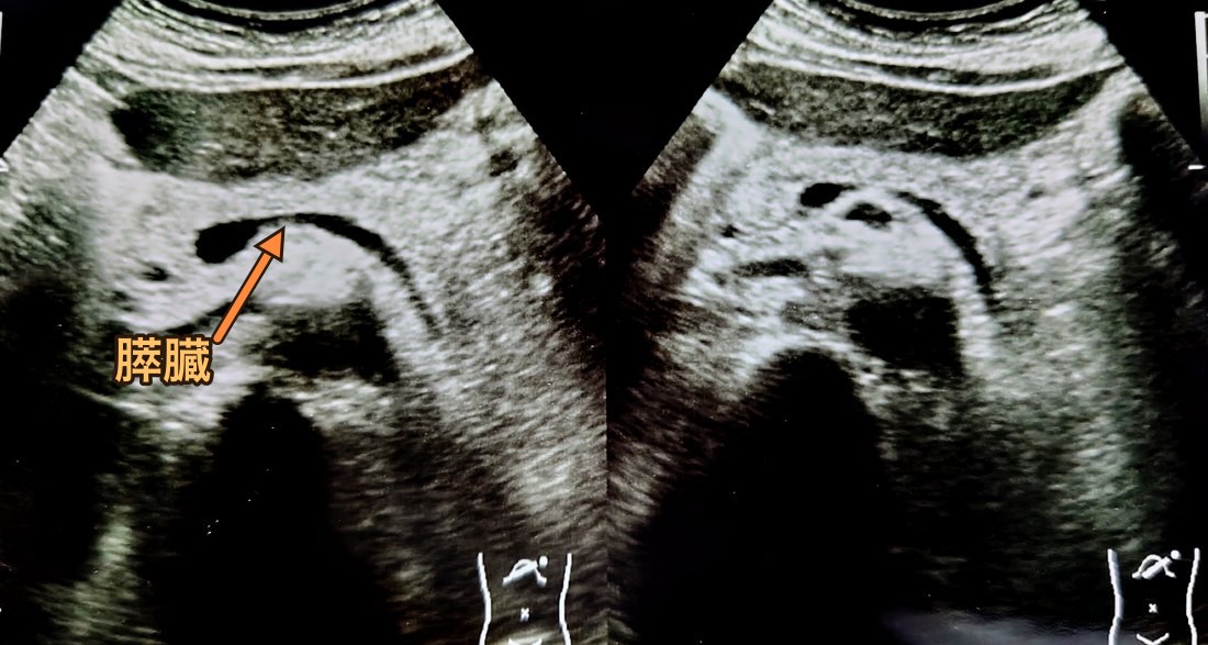 正常な膵臓の腹部エコー画像。膵臓に矢印と名称を入れてあり、周囲との境目がはっきりしている