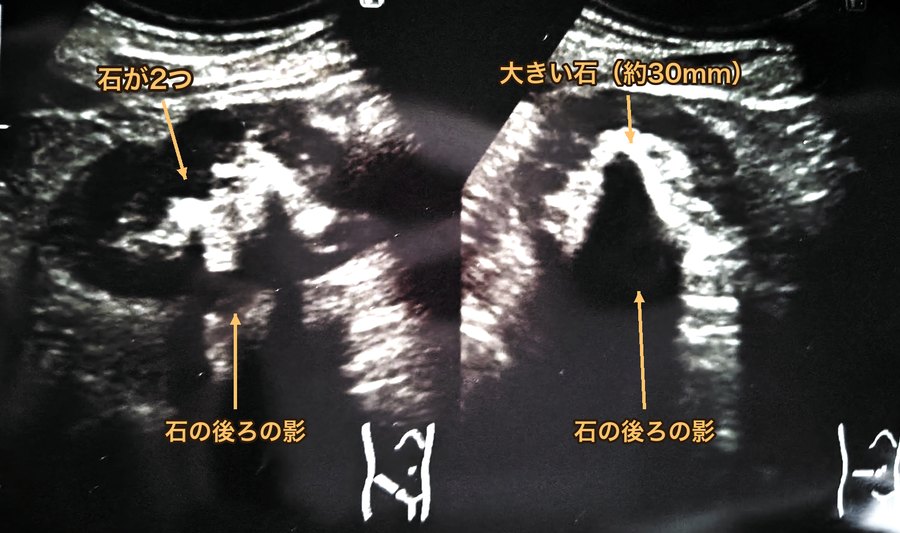 腎臓の石の超音波画像。左は石が2つ、右は約30mmの大きな石。どちらも石の後ろが影のように暗くなっている