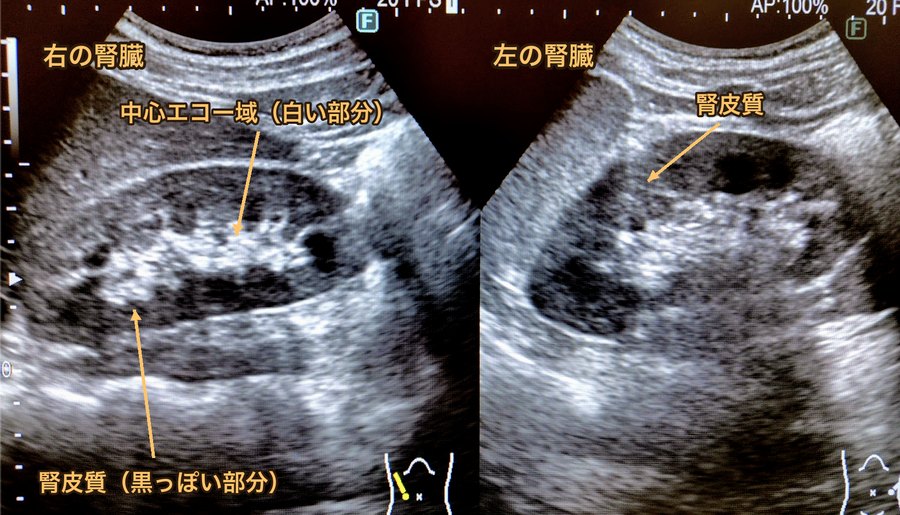 腎臓の超音波画像。外側の黒っぽい腎皮質と、中心の白い中心エコー域に名前を入れたもの
