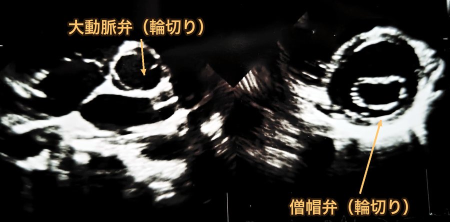 心臓の超音波画像。左は大動脈弁、右は僧帽弁を輪切りにして見たところ