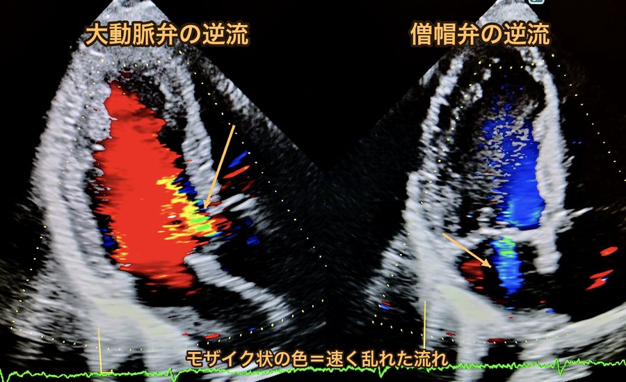 心臓の超音波画像。左は大動脈弁の逆流、右は僧帽弁の逆流を色で表示したもの。逆流のところはモザイク状の色に見える