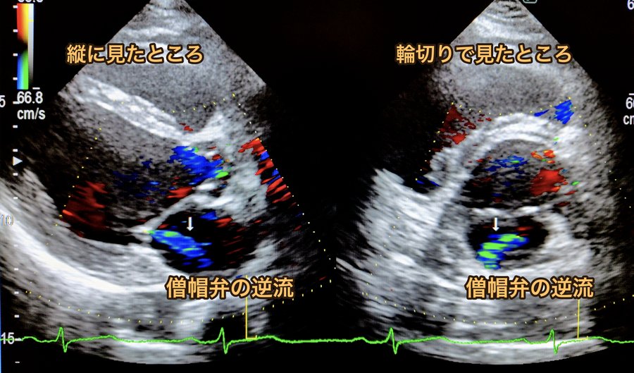 心臓の超音波画像。僧帽弁の逆流を、縦に見たところと輪切りで見たところ