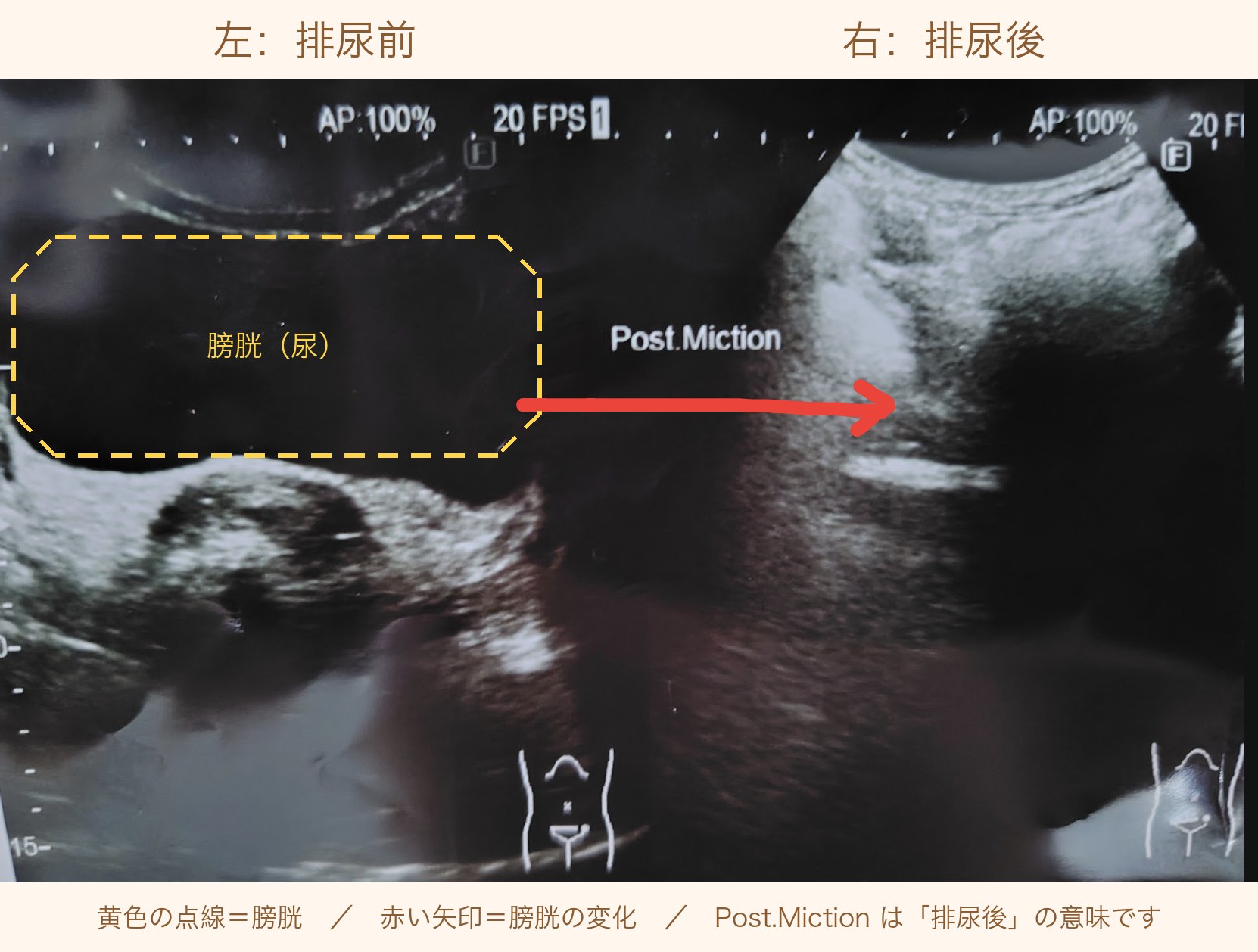 筆者自身の排尿前と排尿後の膀胱エコー画像。排尿前は黒い膀胱がはっきり見え、排尿後は写っていない